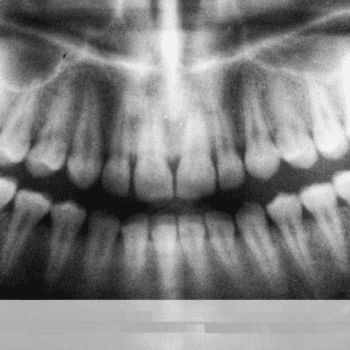 Teeth Scan